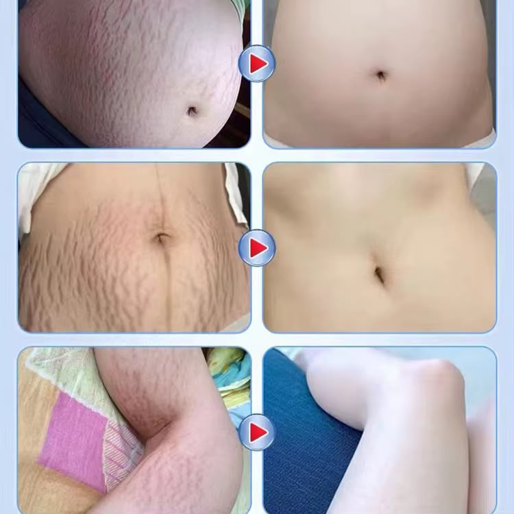 MÔOYAM Stretch Marks Oil — Huile Anti-Vergetures